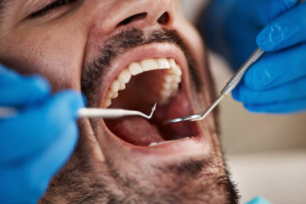 Best Knocked-Out Tooth (Avulsed Tooth) Treatment in East Pepperell, MA
